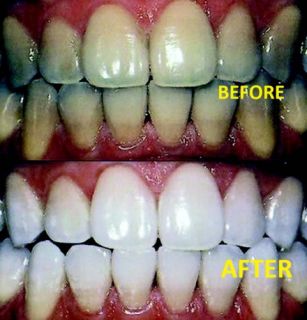 home Laser Tooth Whitening Teeth Bleaching 3 Gel Kit with 