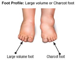   Edema, Charcot, Elephantiasis, Hammer Toes, Bunions, and Deformities